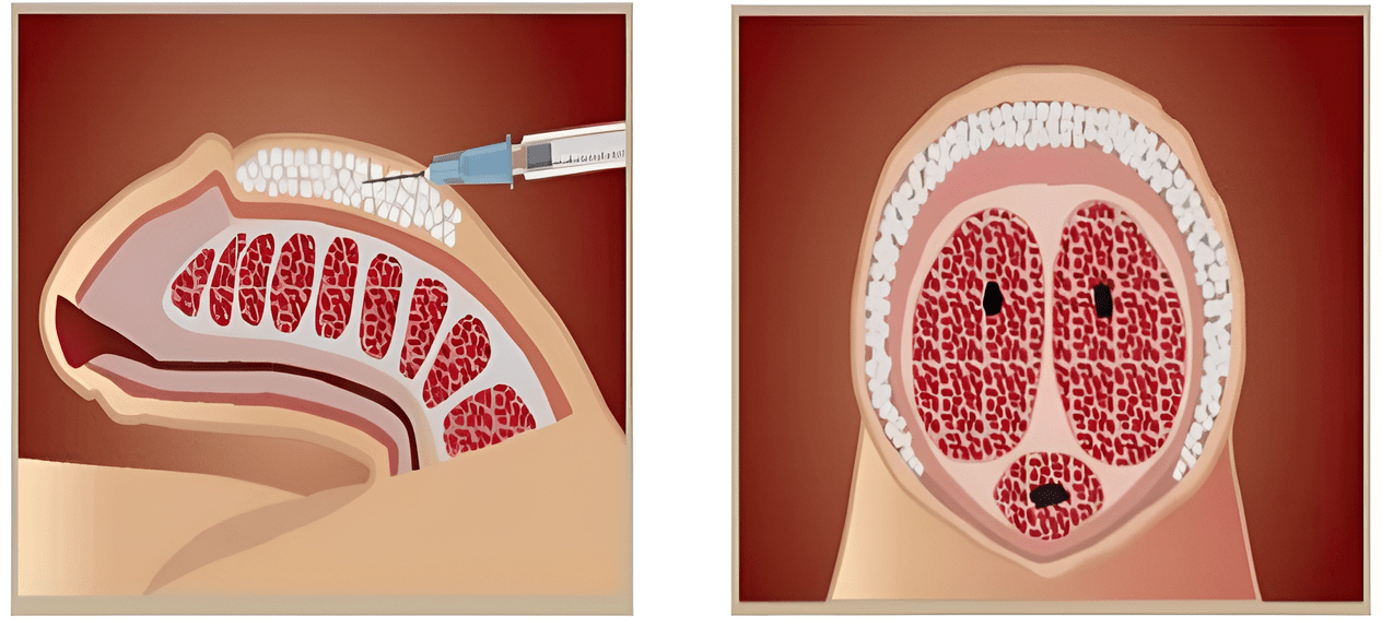 Filler injection sites