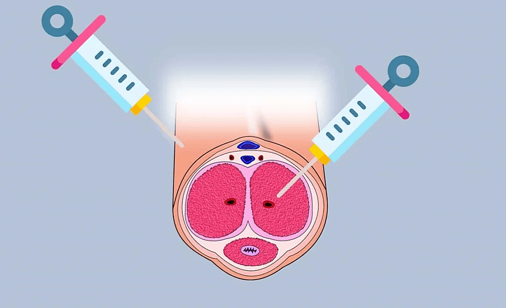 Hyaluronic acid injection sites