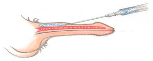 Dick filler injection