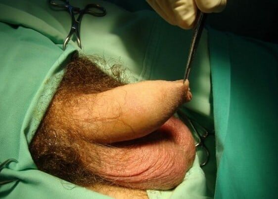 Penis enlargement surgery