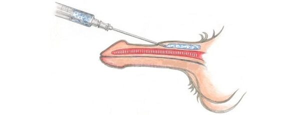 Lipofilling, which allows you to increase the size of the phallus
