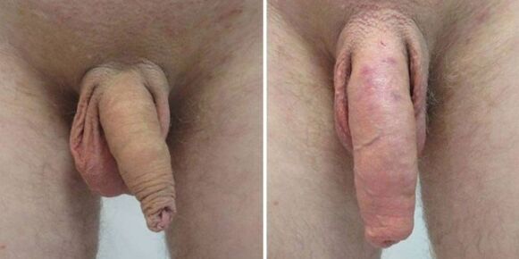 Penis before and after putting on weight